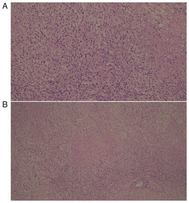 A rare and challenging pediatric case of drug toxicity and immune reconstitution inflammatory syndrome during the treatment of intracranial tuberculoma: A case report.