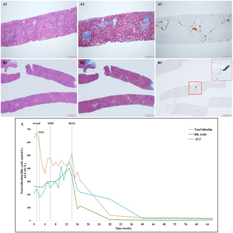 Odevixibat as a possible rescue therapy in a pediatric patient with vanishing bile ducts syndrome associated with ethosuximide-induced DILI-DRESS.