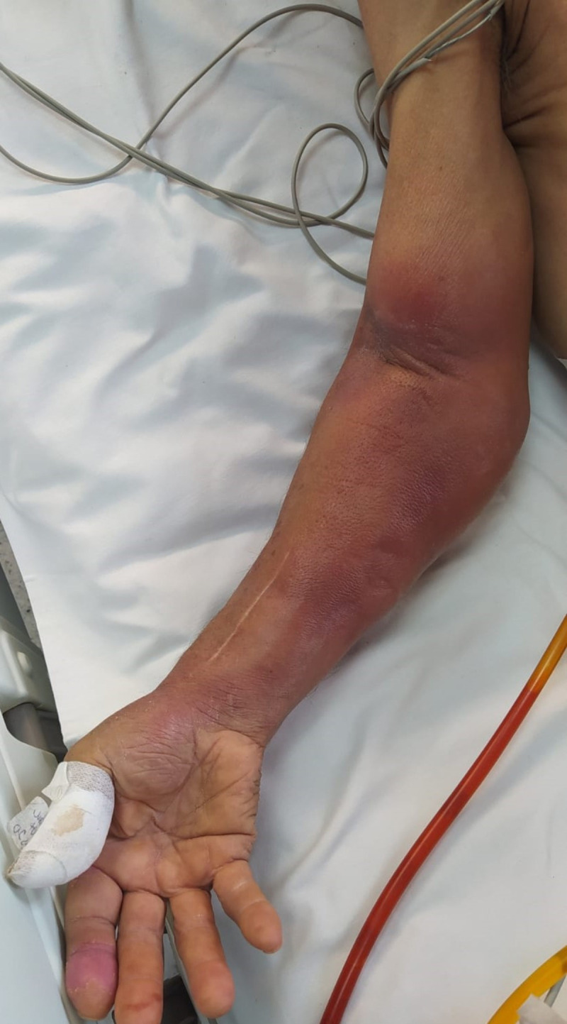 Tuberculous Necrotizing Fasciitis in a Patient with Rheumatoid Arthritis on Anti-TNF Treatment: A Case Report.