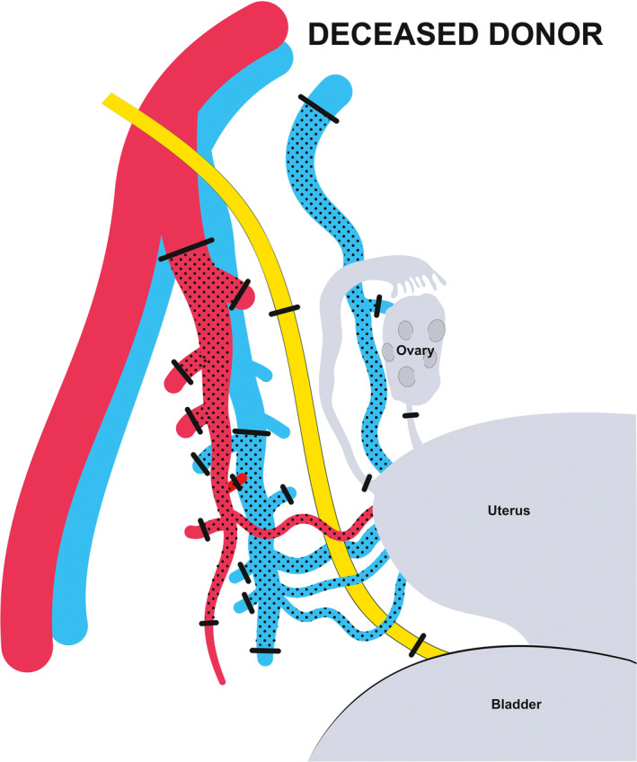 Uterus transplantation: A clinical breakthrough after systematic preclinical research.