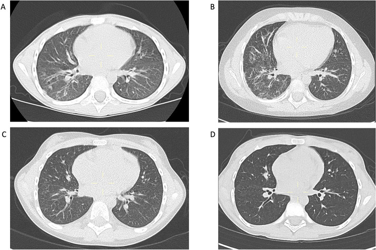 Successful treatment of an anti-MDA5 antibody-positive Juvenile Dermatomyositis patient with refractory interstitial lung disease using tofacitinib.