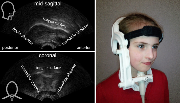 Ultrasound Tongue Imaging in Research and Practice with People with Cleft Palate ± Cleft Lip.