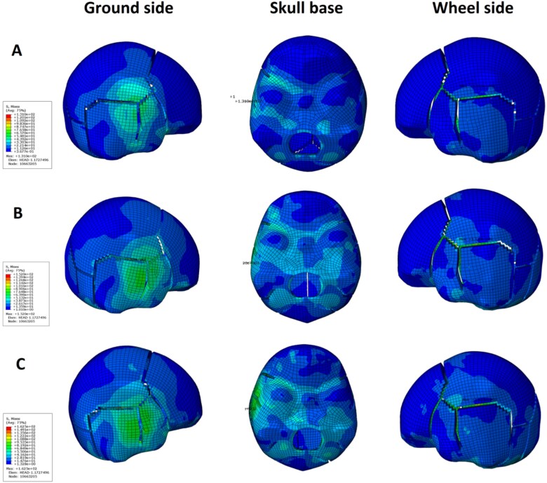 Case analysis and finite element analysis of adult head skull fractures in people run over by motor vehicles.