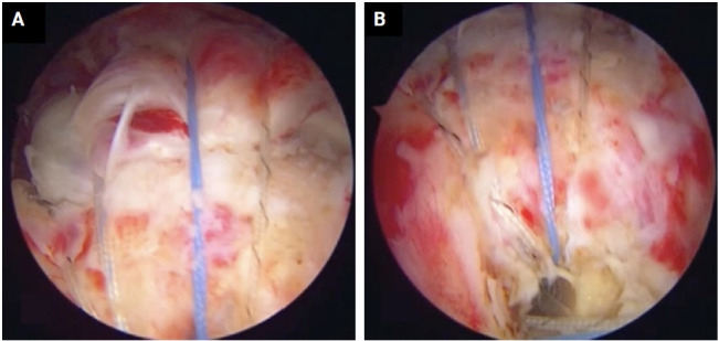 Evaluating transosseous anchorless repair for arthroscopic rotator cuff surgery: a comparative study with double row anchor repair.