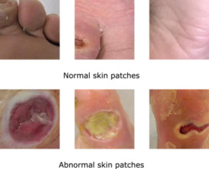A feature explainability-based deep learning technique for diabetic foot ulcer identification.