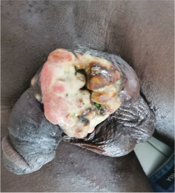 Clinical forms of 5 cases of circumcised penile cancer in immunocompetent subjects in Abidjan (Ivory Coast).