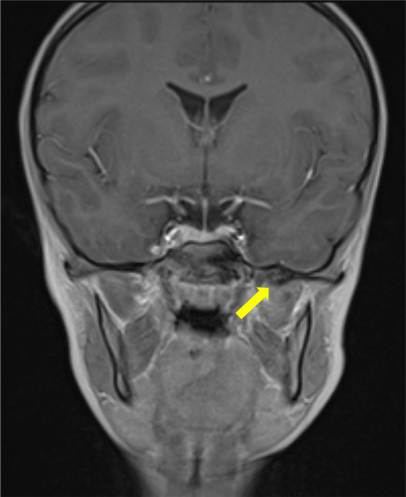 Calcification of the Sphenomandibular Ligament: A Rare Case of Restricted Mouth Opening in a Pediatric Patient.