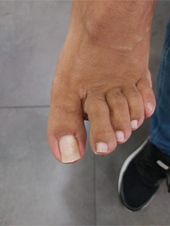 <i>Curvularia lunata</i>-Induced Onychomycosis in an Unlikely Host: A Case Report.