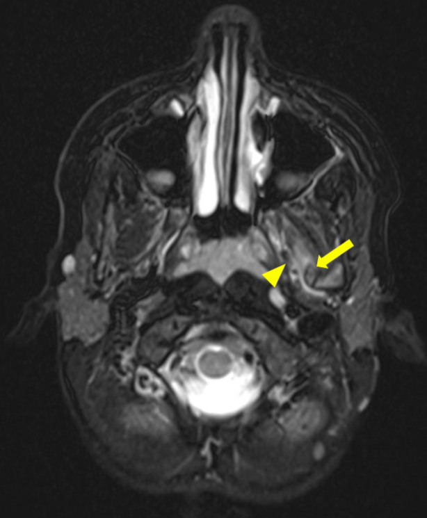 Calcification of the Sphenomandibular Ligament: A Rare Case of Restricted Mouth Opening in a Pediatric Patient.