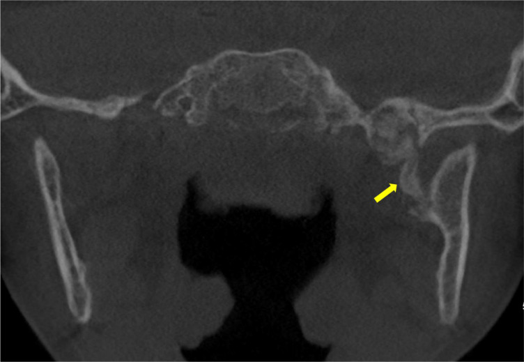 Calcification of the Sphenomandibular Ligament: A Rare Case of Restricted Mouth Opening in a Pediatric Patient.