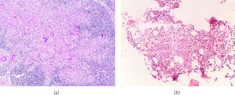 <i>Microscopic polyangiitis</i> With Pauci-Immune Glomerulonephritis Associated With Gastrointestinal Tuberculosis.