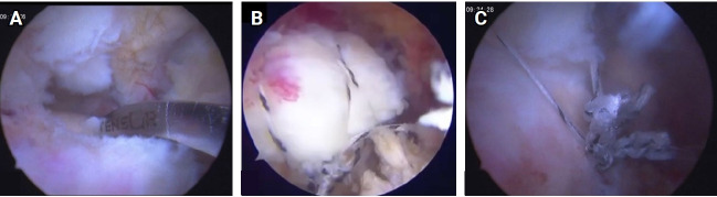 Evaluating transosseous anchorless repair for arthroscopic rotator cuff surgery: a comparative study with double row anchor repair.