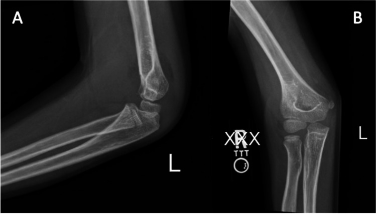 Nonoperative Management of Gartland Type II Supracondylar Humeral Fractures: A Comprehensive Review.