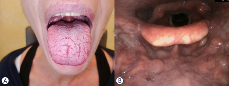 Recurrent respiratory papillomatosis: role of bevacizumab and HPV vaccination. A literature review with case presentations.
