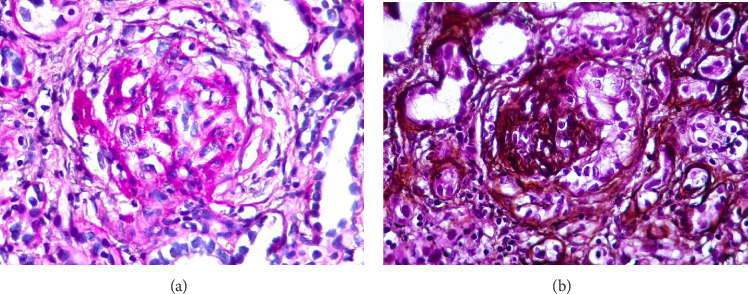 <i>Microscopic polyangiitis</i> With Pauci-Immune Glomerulonephritis Associated With Gastrointestinal Tuberculosis.