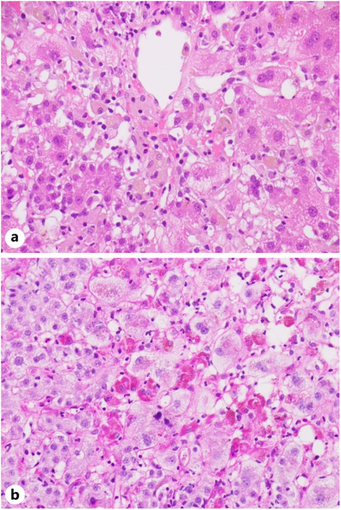 Drug-Induced Liver Injury Associated with Turmeric and Piperine: A Case and Review.