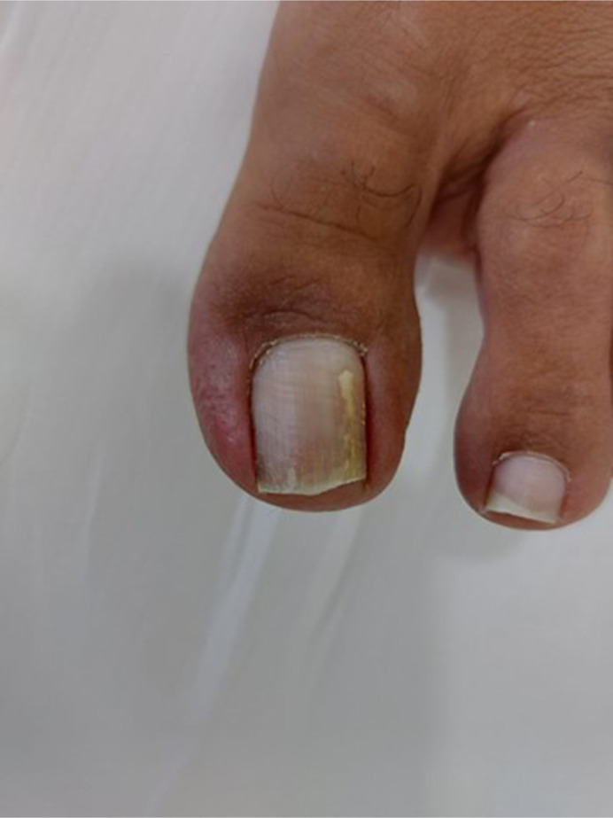 <i>Curvularia lunata</i>-Induced Onychomycosis in an Unlikely Host: A Case Report.