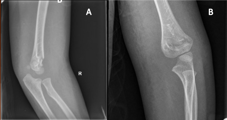Nonoperative Management of Gartland Type II Supracondylar Humeral Fractures: A Comprehensive Review.