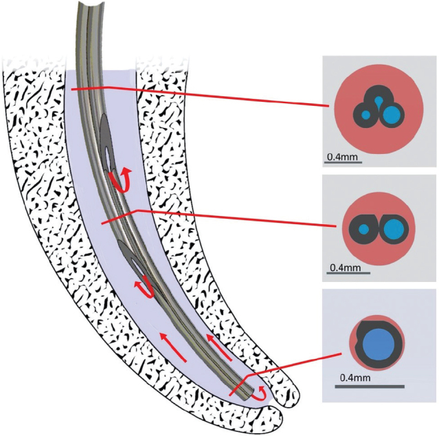 In vitro assessment of needle and irrigant penetration when using different irrigation needle tips.