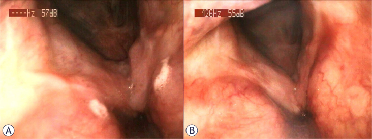 Recurrent respiratory papillomatosis: role of bevacizumab and HPV vaccination. A literature review with case presentations.
