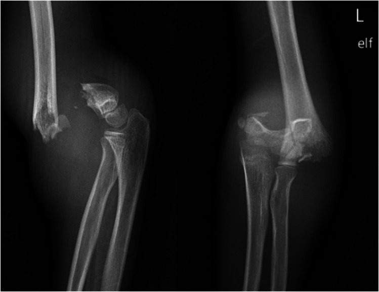Nonoperative Management of Gartland Type II Supracondylar Humeral Fractures: A Comprehensive Review.