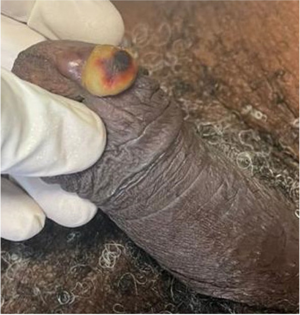 Clinical forms of 5 cases of circumcised penile cancer in immunocompetent subjects in Abidjan (Ivory Coast).