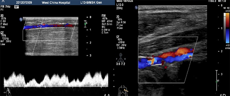 Klippel-Trenaunay Syndrome in the Distal Part of the Unilateral Upper Limb and Venous Deficiency: A Case Report.