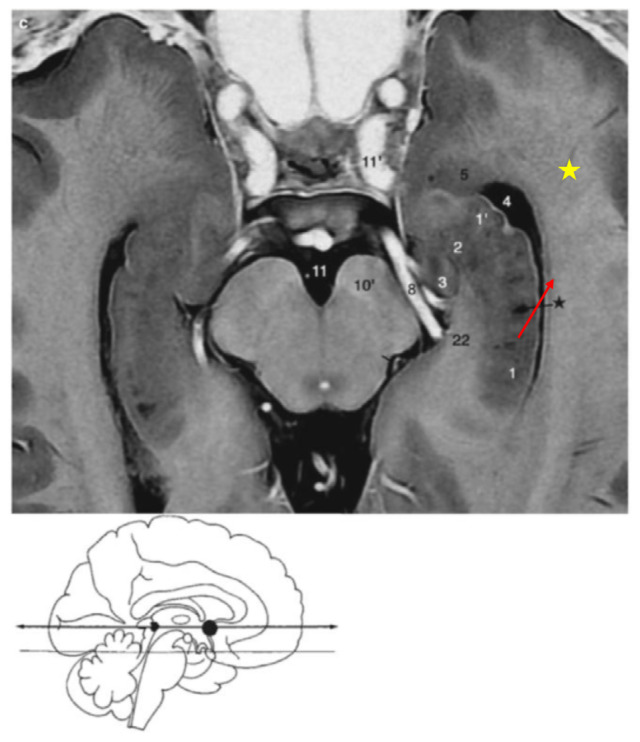 Delineating Neuroanatomical Structures for the Measurement of Temporal Horn Dilatation.