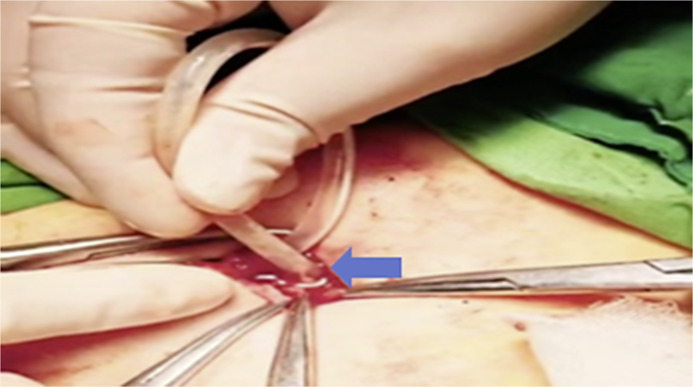 A Novel Approach to Repositioning Peritoneal Dialysis Catheters.
