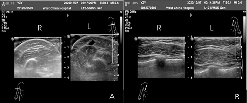 Klippel-Trenaunay Syndrome in the Distal Part of the Unilateral Upper Limb and Venous Deficiency: A Case Report.