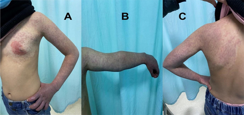 Klippel-Trenaunay Syndrome in the Distal Part of the Unilateral Upper Limb and Venous Deficiency: A Case Report.