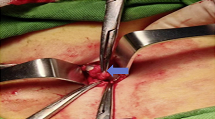 A Novel Approach to Repositioning Peritoneal Dialysis Catheters.