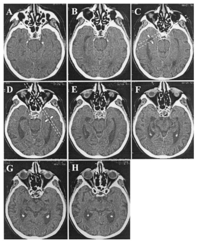 Delineating Neuroanatomical Structures for the Measurement of Temporal Horn Dilatation.