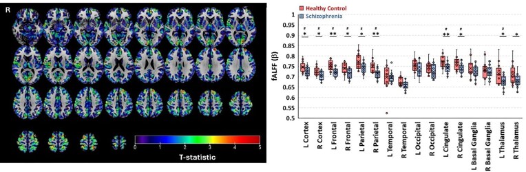 Abnormal arteriolar blood volume measured by 3D inflow-based vascular-space-occupancy (iVASO) MRI and resting-state BOLD fluctuations at 7 T in individuals with recent-onset schizophrenia.