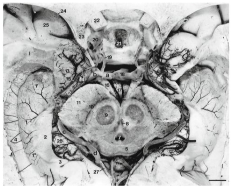 Delineating Neuroanatomical Structures for the Measurement of Temporal Horn Dilatation.