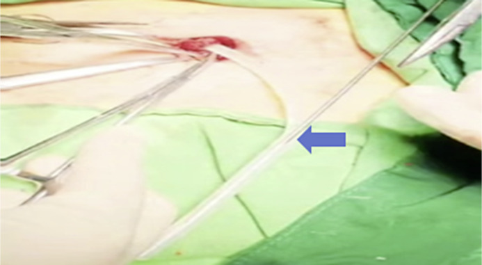 A Novel Approach to Repositioning Peritoneal Dialysis Catheters.