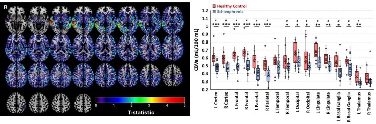 Abnormal arteriolar blood volume measured by 3D inflow-based vascular-space-occupancy (iVASO) MRI and resting-state BOLD fluctuations at 7 T in individuals with recent-onset schizophrenia.