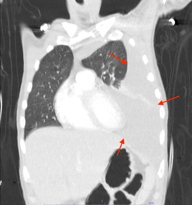 An Unusual Case of Extracavitary/Solid Variant Primary Effusion Lymphoma With Associated Hemophagocytic Lymphohistiocytosis.