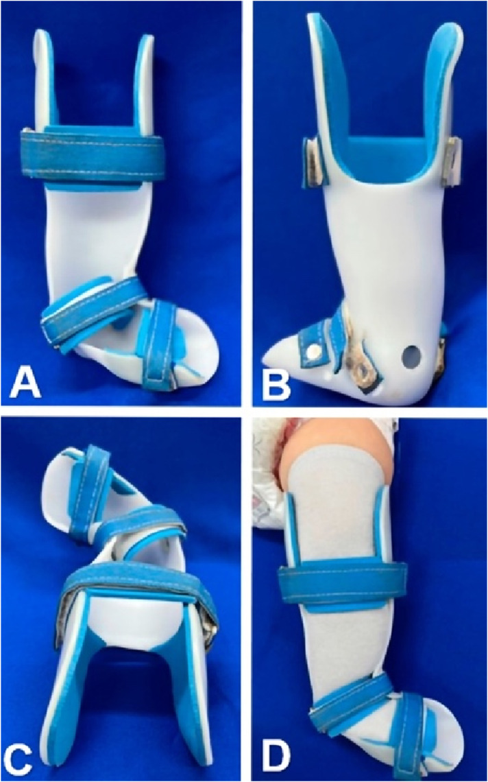 Design and evaluation of a unilateral brace for preventing clubfoot relapse: A prospective study.