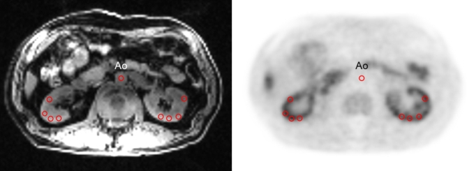 Relationship between renal oxidative stress levels and disease severity in patients with chronic kidney disease assessed by [Cu-64]ATSM PET/MRI.