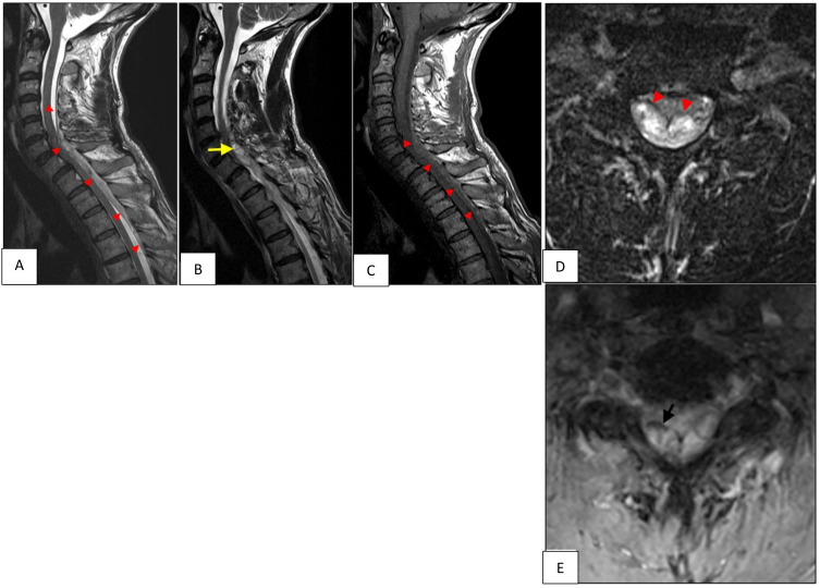 Spontaneous Spinal Epidural Hematoma Under Rivaroxaban and Clopidogrel: A Case Report and Literature Review.