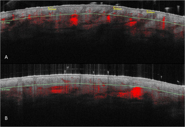 Non-Invasive Imaging for the Evaluation of a New Oral Supplement in Skin Aging: A Case-Controlled Study.