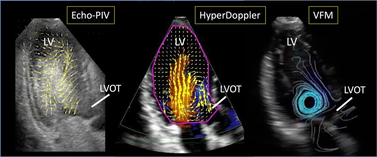 Intracardiac flow dynamics in mitral regurgitation: state of the art.