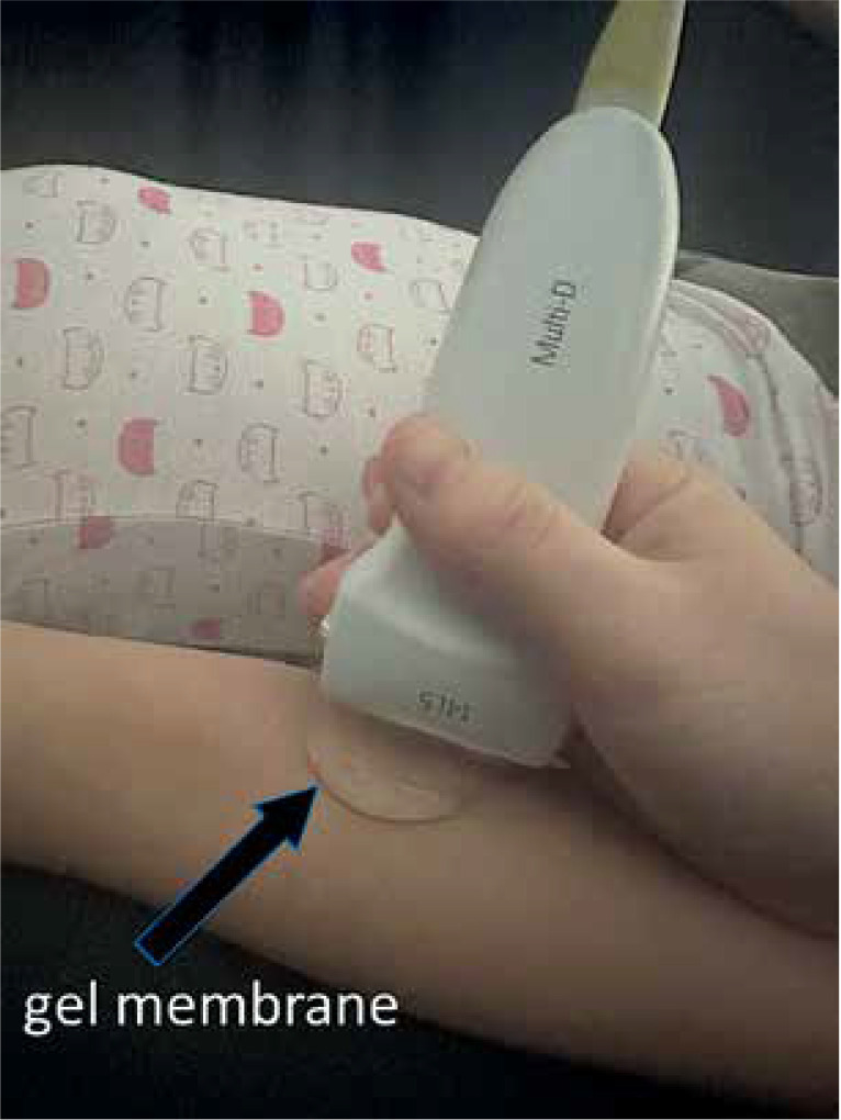 The effect of house dust mite sensitization on skin dermis thickness in children with allergic respiratory diseases.