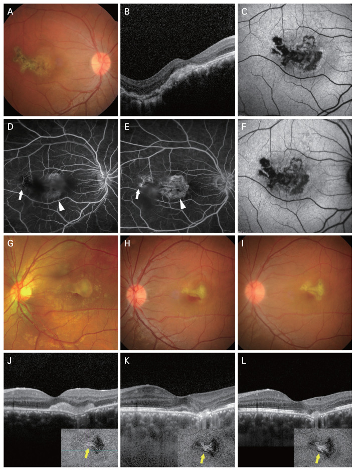 Macular Serpiginous Choroidopathy with Secondary Choroidal Neovascularization: A Case Report.