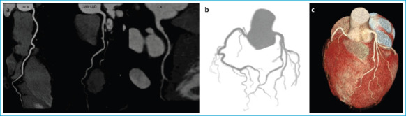 Prognostic Value of Epicardial Fat Volume Quantification Related to Coronary Artery Calcium Score and Degree of Stenosis on Coronary CT Angiography.