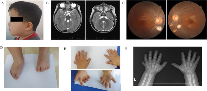 A Novel Pathogenic Splicing Mutation of <i>OFD1</i> is Responsible for a Boy with Joubert Syndrome Exhibiting Orofaciodigital Spectrum Anomalies, Polydactyly and Retinitis Pigmentosa.