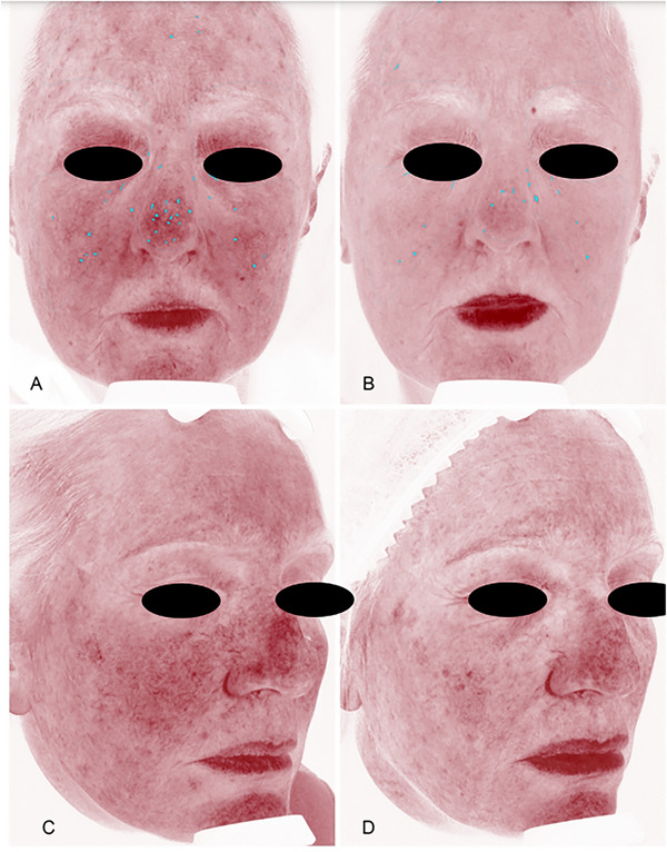 Non-Invasive Imaging for the Evaluation of a New Oral Supplement in Skin Aging: A Case-Controlled Study.