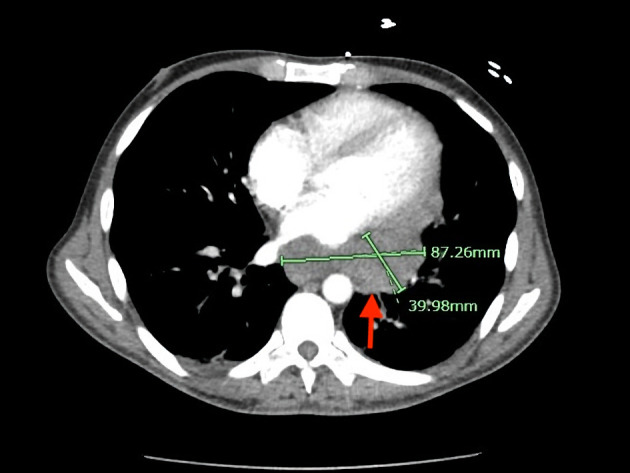 An Unusual Case of Extracavitary/Solid Variant Primary Effusion Lymphoma With Associated Hemophagocytic Lymphohistiocytosis.