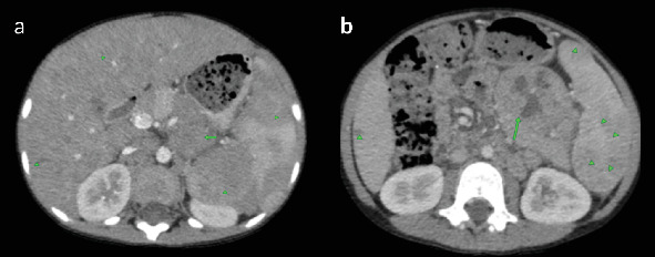 Pediatric T-Cell/Histiocyte-Rich Large B-Cell Lymphoma (THRLBC) in an 8-Year-Old Male Child: A Case Report.